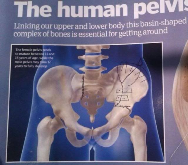 Broken Pelvis Realistic Timescales For Rehabilitation And Recovery 